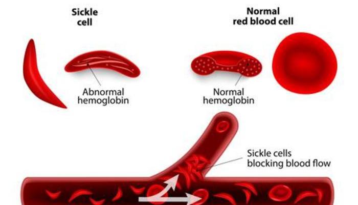 What Is Sickle Cell Disease?
